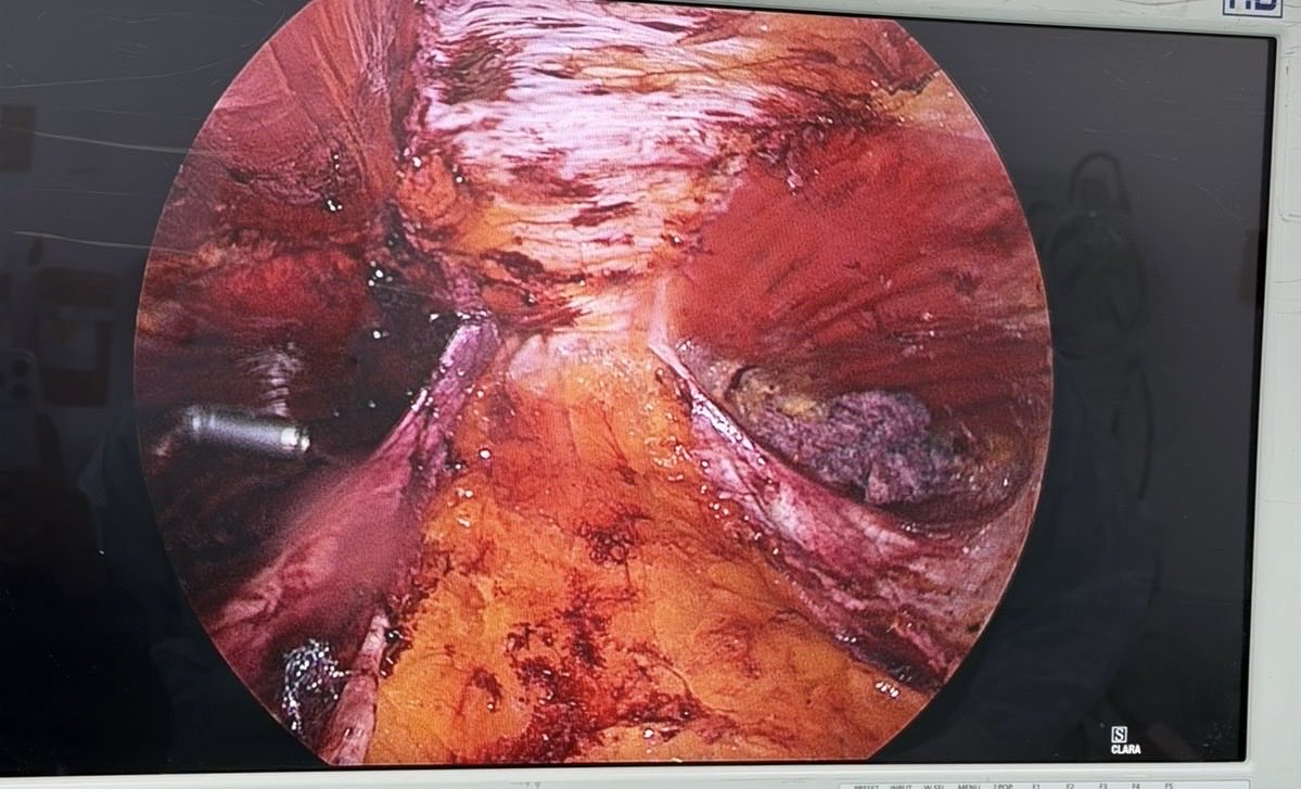 jdmmc1's tweet photo. La técnica de acceso intercostal para el e Tep ventral es cómoda y más ergonómica para suturar la pared 
#herniaventral #laparoscopiaavanzada
#medellin 
#herniacompleja https://t.co/KND1Xy6eru