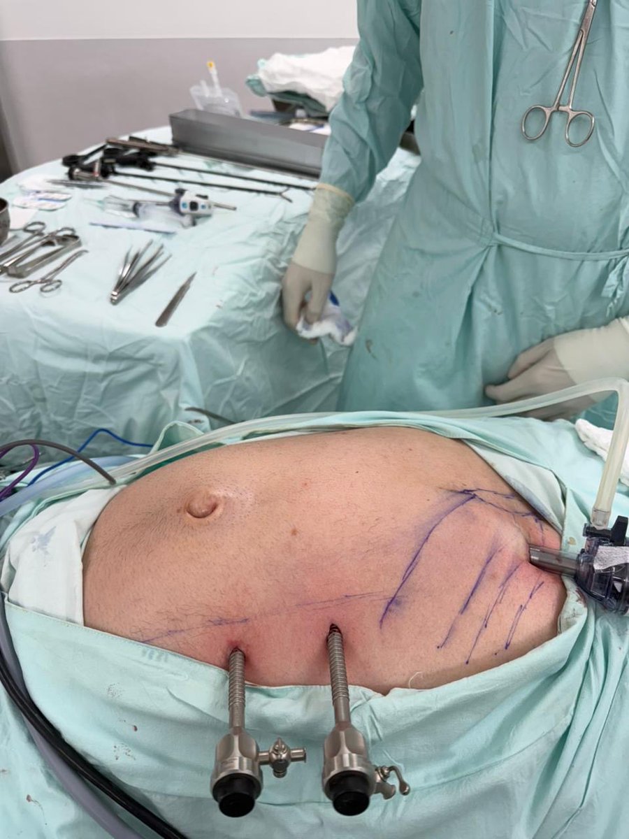 jdmmc1's tweet photo. La técnica de acceso intercostal para el e Tep ventral es cómoda y más ergonómica para suturar la pared 
#herniaventral #laparoscopiaavanzada
#medellin 
#herniacompleja https://t.co/KND1Xy6eru