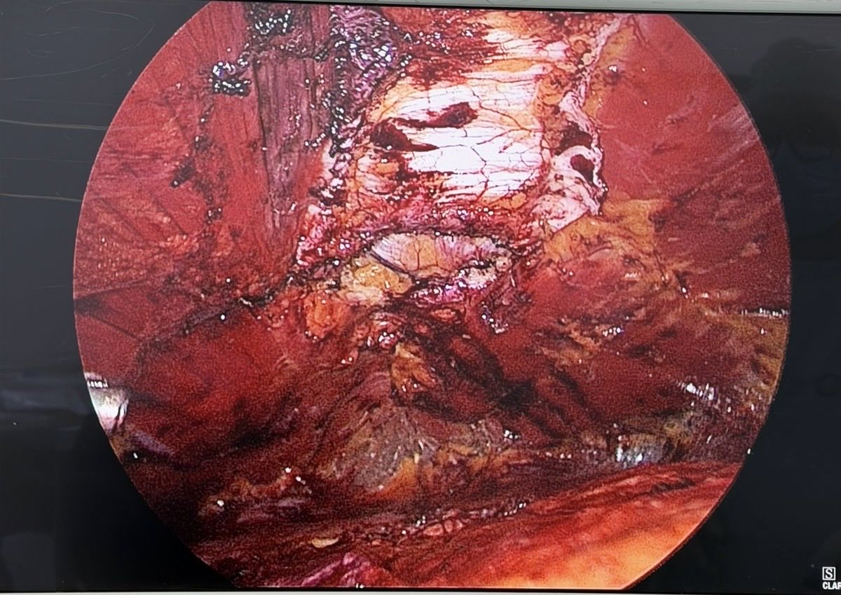 jdmmc1's tweet photo. La técnica de acceso intercostal para el e Tep ventral es cómoda y más ergonómica para suturar la pared 
#herniaventral #laparoscopiaavanzada
#medellin 
#herniacompleja https://t.co/KND1Xy6eru