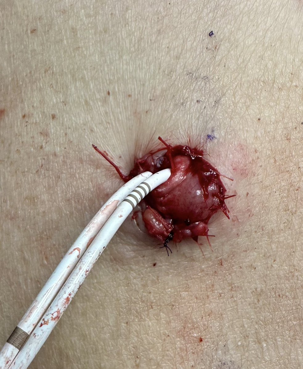 MUSC Urologic Oncology Program tweet media