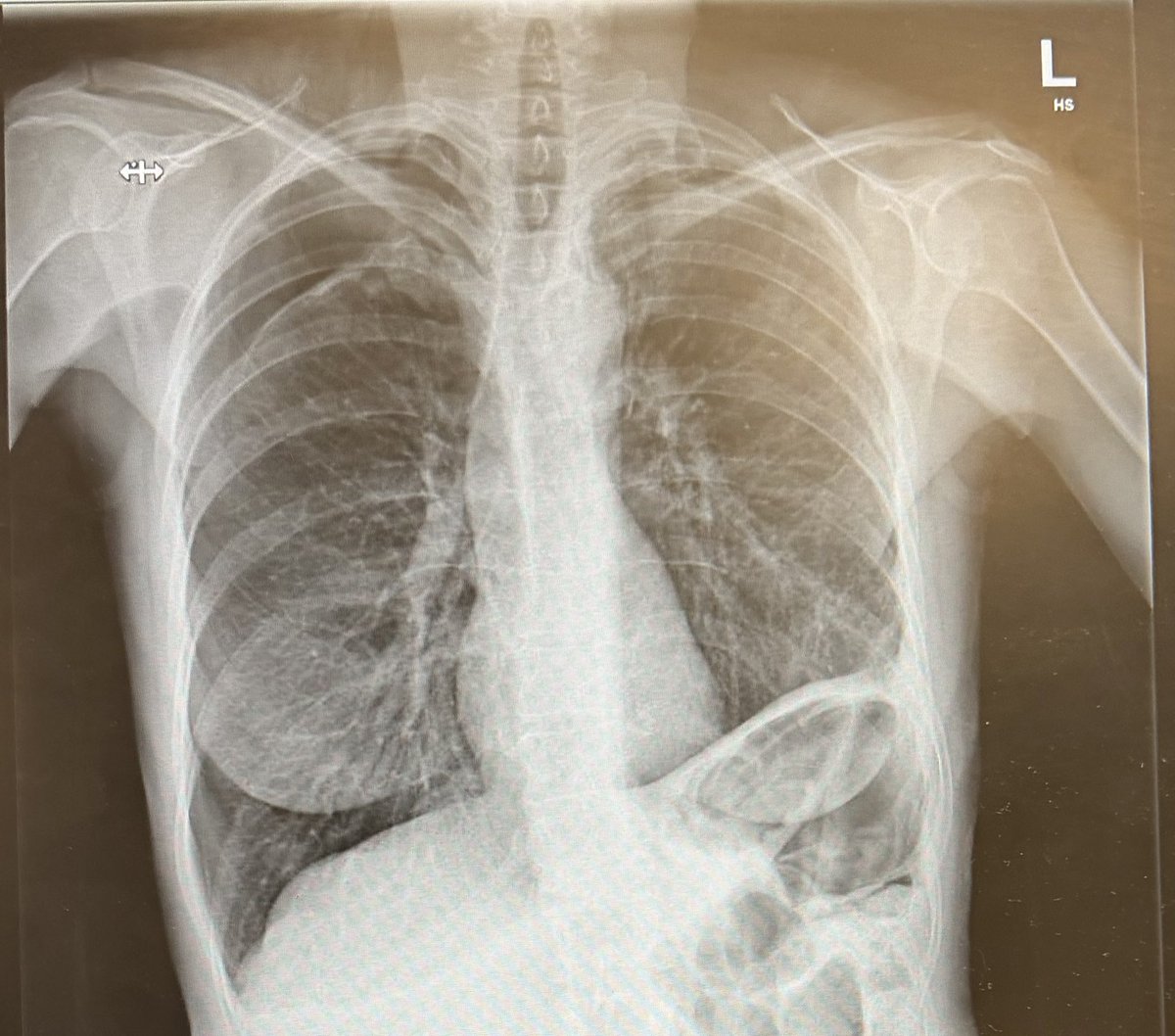 Diagnosis?

<a href="/drobiy12/">Dr. El_Nino</a> 
<a href="/dr_manish_ydv/">अहिरावण</a> 
<a href="/Dr_Shiv_kumar_/">Dr. Shiv_Kumar</a> 
<a href="/SameerYogi14/">Dr Ajay yadav</a> 
<a href="/drabdulhameed07/">Dr Abdul Hameed 🩺</a> 
<a href="/albertoortegana/">C.Alberto Ortega</a> 
<a href="/fzn733/">Faizan A.</a> 
<a href="/usernamee389/">.</a> 
<a href="/MiguelP23970914/">Antonio Arroyo, MD. Medico Cirujano.</a>