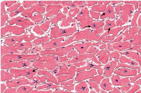 Most likely diagnosis for this histology slide?
#neetpg2026 #MedTwitter <a href="/ChShafiullah15/">Chaudhary Shafiullah</a> <a href="/Dr_Shiv_kumar_/">Dr. Shiv_Kumar</a> <a href="/albertoortegana/">C.Alberto Ortega</a> <a href="/DrAkhilX/">Dr. Akhil 🇮🇳</a> <a href="/DrMedica_13/">Dr. Medica🩺</a> <a href="/MiguelP23970914/">Antonio Arroyo, MD. Medico Cirujano.</a>