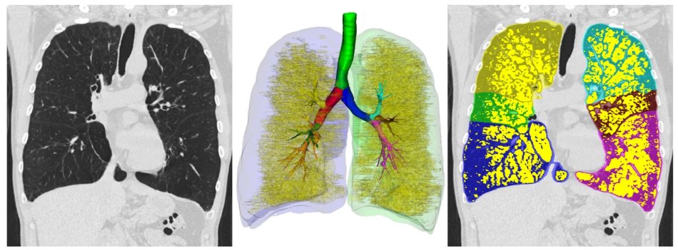 RespiratoryBMC's tweet image. 📕Article Alert 📕

Quantitative analysis of chest computed tomography in alpha-1-antitrypsin deficiency
#OpenAccess #Tomography #RespiratoryResearch 

Read the article: doi.org/10.1186/s12931…