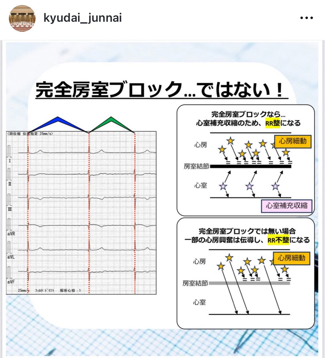 yakabe1206's tweet photo. 九州大学循環器内科では、心電図・循環器を学ぶみなさんを応援しています📣
Instagramには心電図検定対策として講義スライドを載せていますので、ぜひフォローしてください💕

https://t.co/1tdLjncgCd https://t.co/MzXRiSWNO5