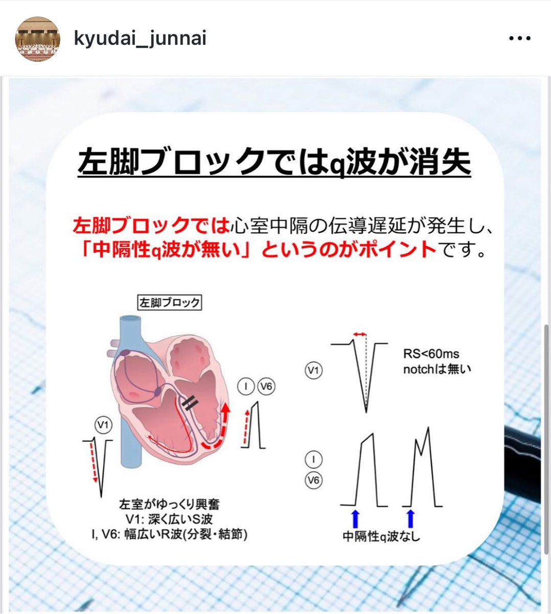 yakabe1206's tweet photo. 九州大学循環器内科では、心電図・循環器を学ぶみなさんを応援しています📣
Instagramには心電図検定対策として講義スライドを載せていますので、ぜひフォローしてください💕

https://t.co/1tdLjncgCd https://t.co/MzXRiSWNO5