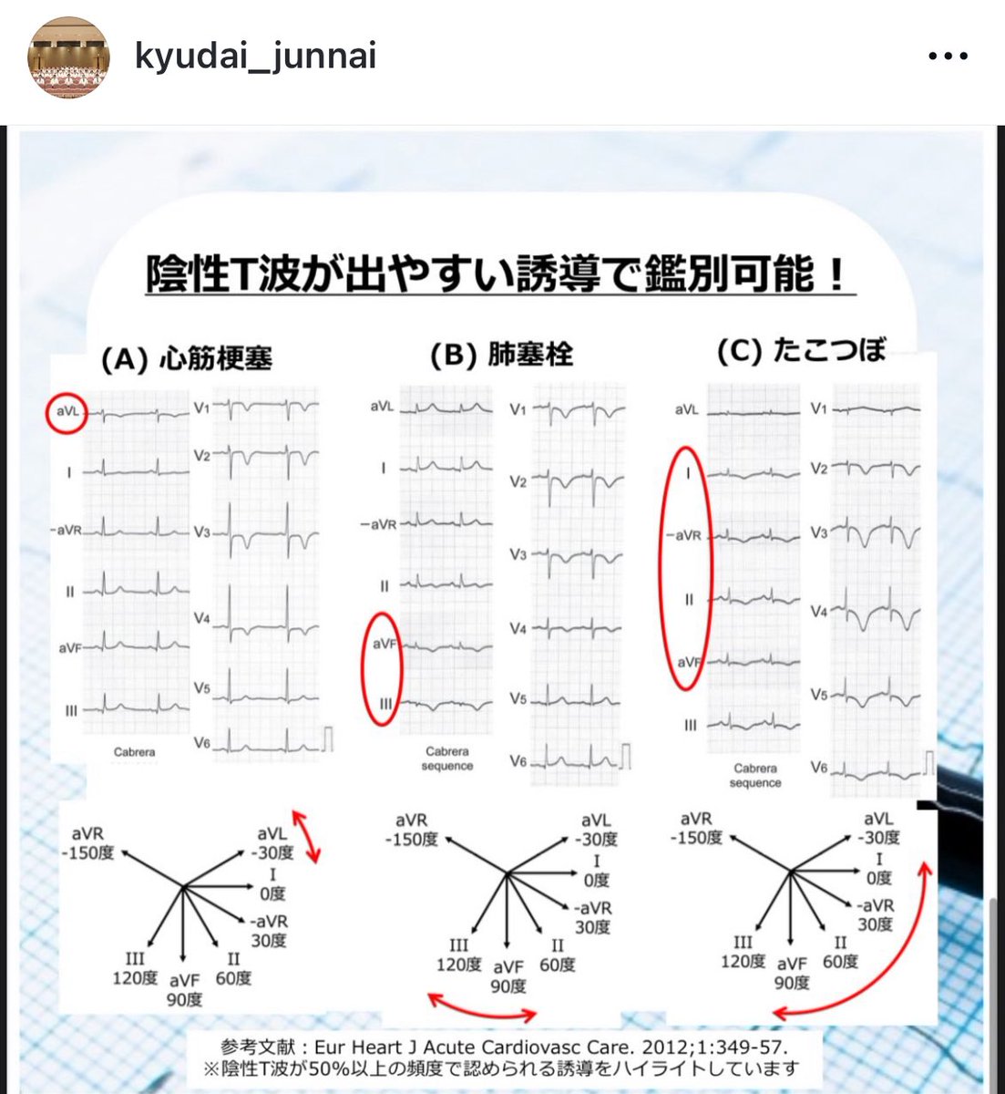 yakabe1206's tweet photo. 九州大学循環器内科では、心電図・循環器を学ぶみなさんを応援しています📣
Instagramには心電図検定対策として講義スライドを載せていますので、ぜひフォローしてください💕

https://t.co/1tdLjncgCd https://t.co/MzXRiSWNO5