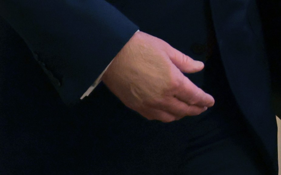 atrupar's tweet image. Trump's discolored hand as it appeared today

(Anna Moneymaker/Getty)