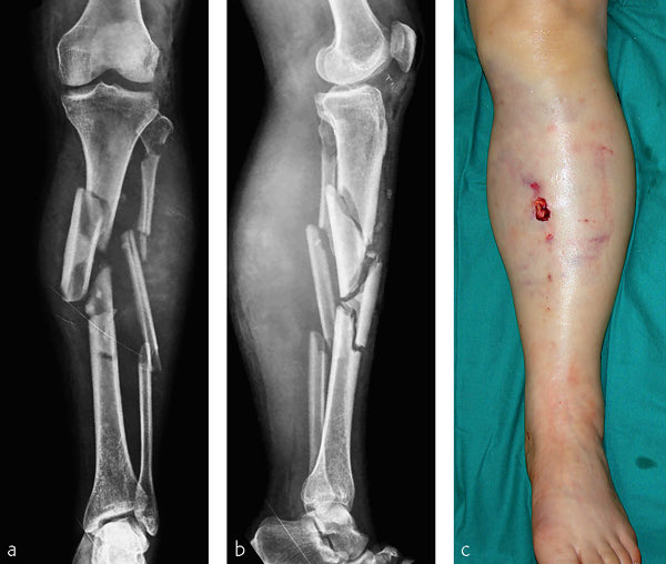 Lindsey Vonn

When she said she would need multiple surgeries she wasn’t kidding. 

She just completed her 3rd.

When I say this was a ‘bad’ fracture I wasn’t kidding.

This is called an external fixator (‘x-fix’) and is being used to help stabilize the fractured tibia (and maybe