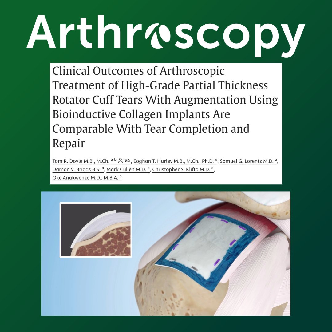 ArthroscopyJ's tweet image. Study shows that arthroscopic treatment with bioinductive collagen implants offers a promising approach to enhance healing while preserving native tissue.
#RotatorCuff #ShoulderSurgery #SportsMedicine #Orthopedics #Bioinductive
sciencedirect.com/science/articl…
@Okwenze @nyulangone