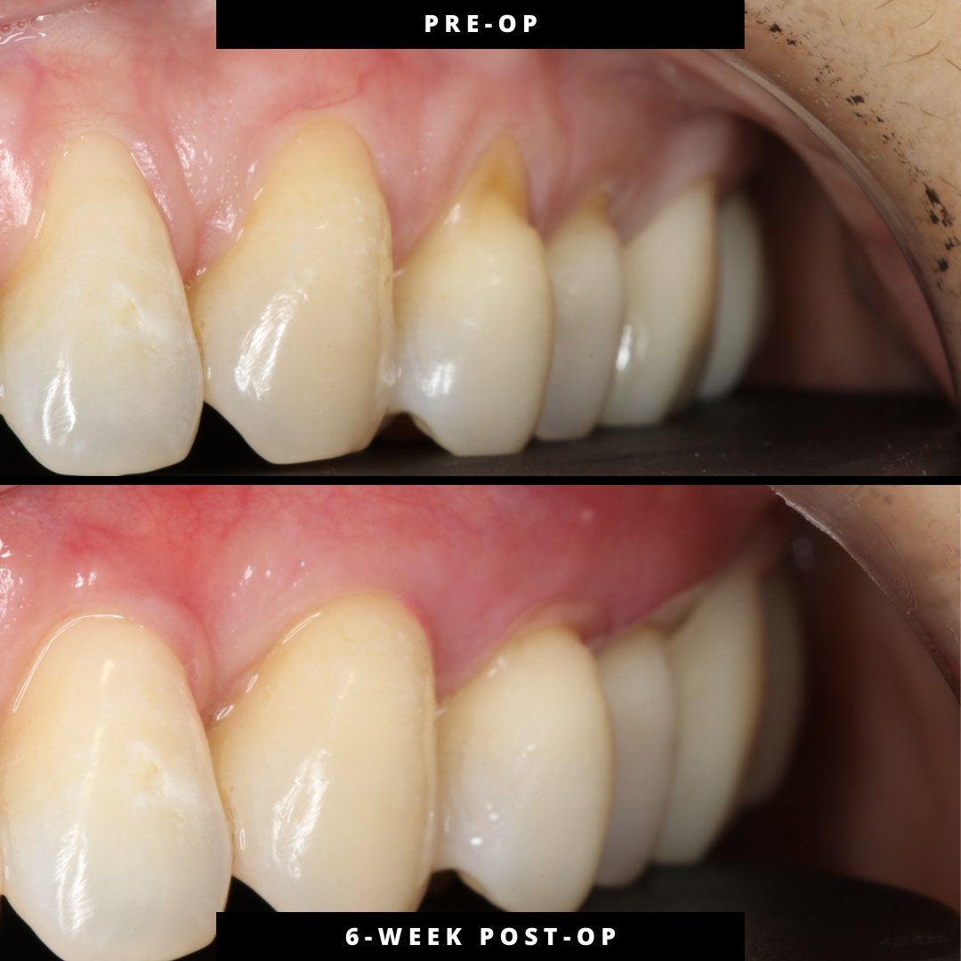 JohnChaodds's tweet photo. Clinical Observation — Gingival Recession
Pinhole® Surgical Technique | Teeth #3, 4, 6–12
Procedure: 12/30/25 (3:35–5:15 PM) | Interval: 6 weeks
Early tissue maturation observed; remodeling ongoing. https://t.co/F46aBGCuky