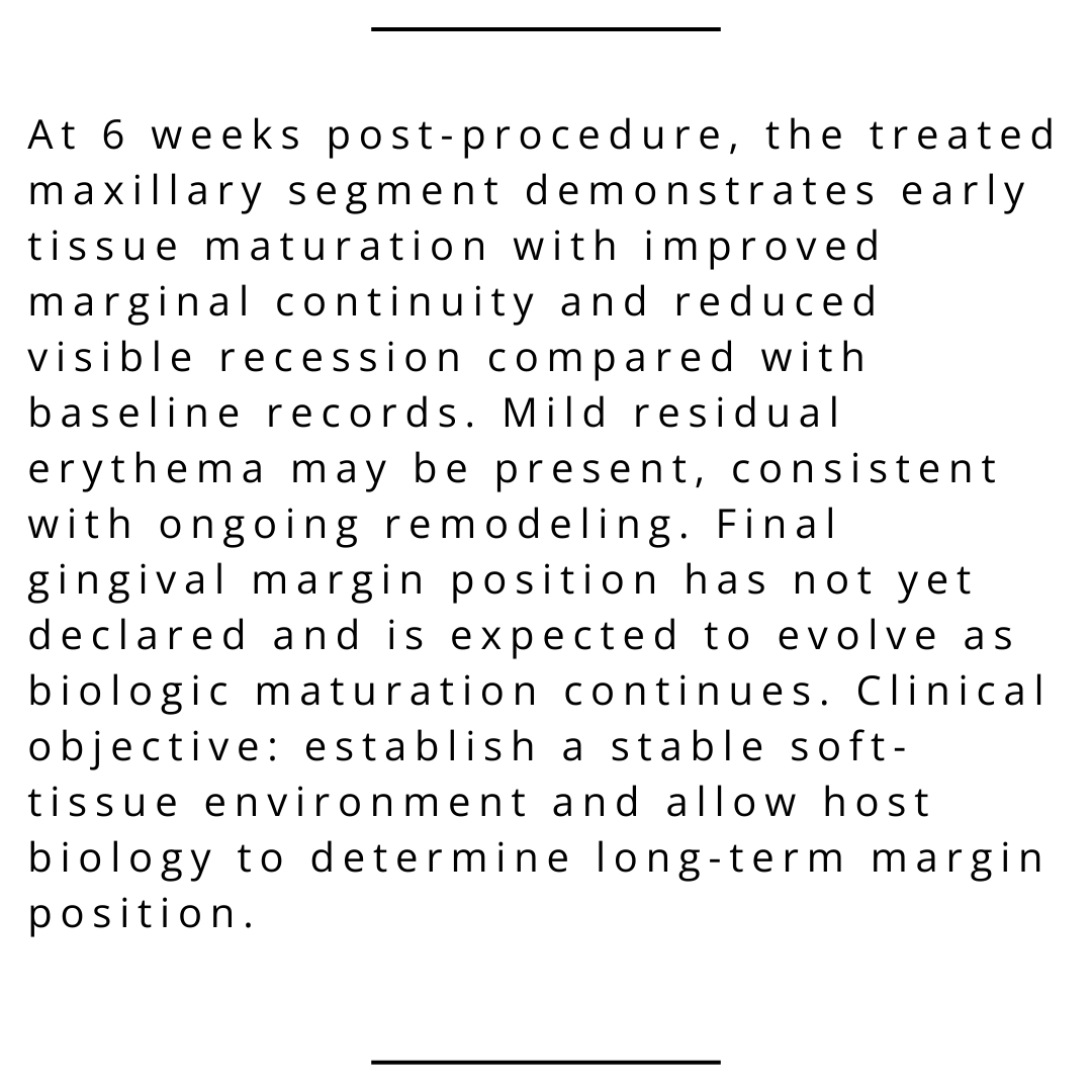 JohnChaodds's tweet photo. Clinical Observation — Gingival Recession
Pinhole® Surgical Technique | Teeth #3, 4, 6–12
Procedure: 12/30/25 (3:35–5:15 PM) | Interval: 6 weeks
Early tissue maturation observed; remodeling ongoing. https://t.co/F46aBGCuky