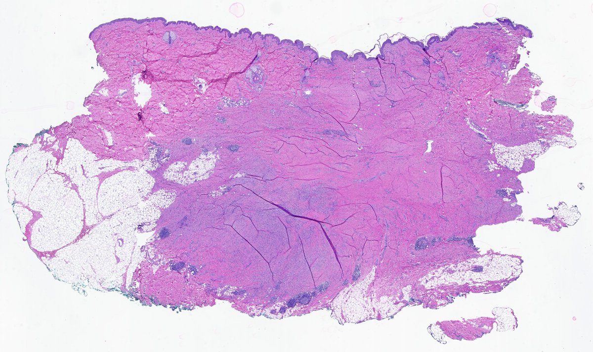 CakePath's tweet image. 🧵Collagenous Dermatofibroma
🌳 Epidermal induction with overlying acanthosis and basal hyperpigmentation
🌀 Poorly cellular interlacing spindle and histiocytic proliferation in the dermis
🧵 Prominent dense, hyalinized (sclerotic) collagen replacing much of the storiform…