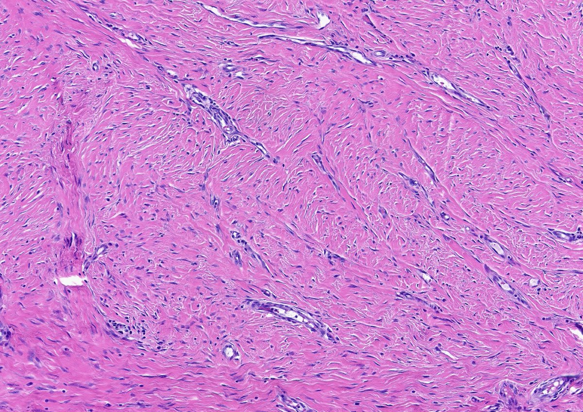 CakePath's tweet image. 🧵Collagenous Dermatofibroma
🌳 Epidermal induction with overlying acanthosis and basal hyperpigmentation
🌀 Poorly cellular interlacing spindle and histiocytic proliferation in the dermis
🧵 Prominent dense, hyalinized (sclerotic) collagen replacing much of the storiform…