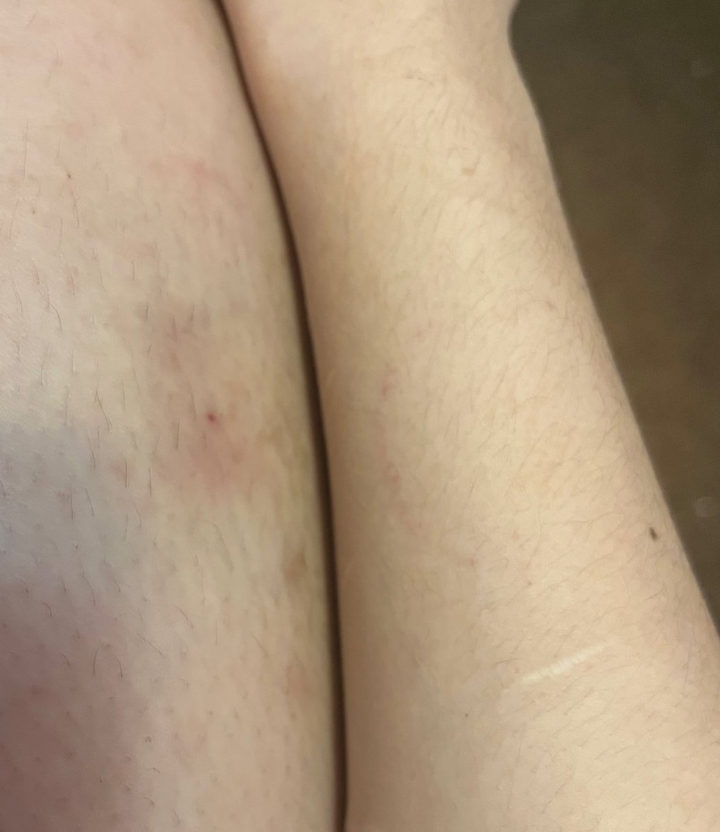 r__x0r's tweet photo. bruises and bite marks hurting myself any other way i can https://t.co/g72GUpCTOv