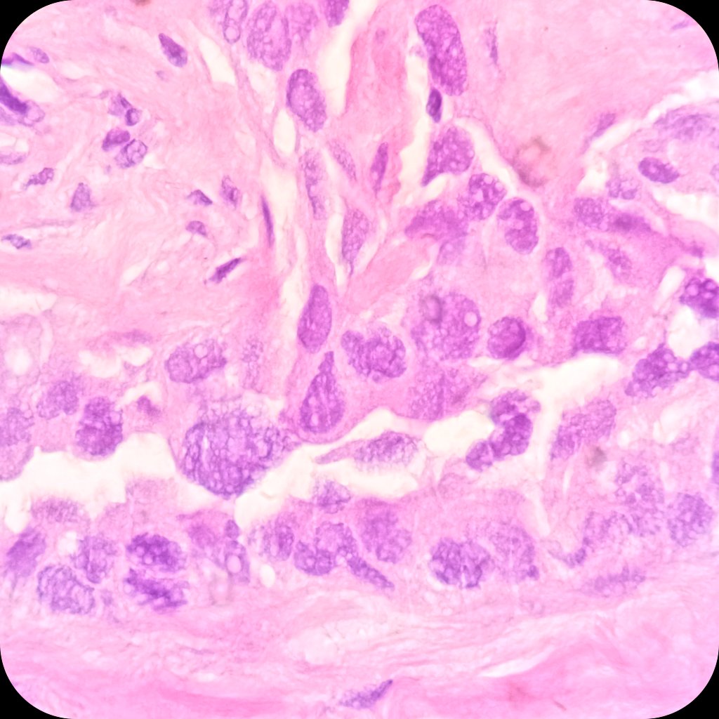 duckhuca's tweet photo. 🫁 Lung mass ➕ enlarged mediastinal lymph node.
❄️ CryoEBUS.
🔬 Adenocarcinoma.
🎚️ Third-level indication for CryoEBUS (need sample for molecular testing).
🔗 https://t.co/lMgeyRAjXr
#LungCancer #LungPath #CryoEBUS https://t.co/D0hzkqwnK0