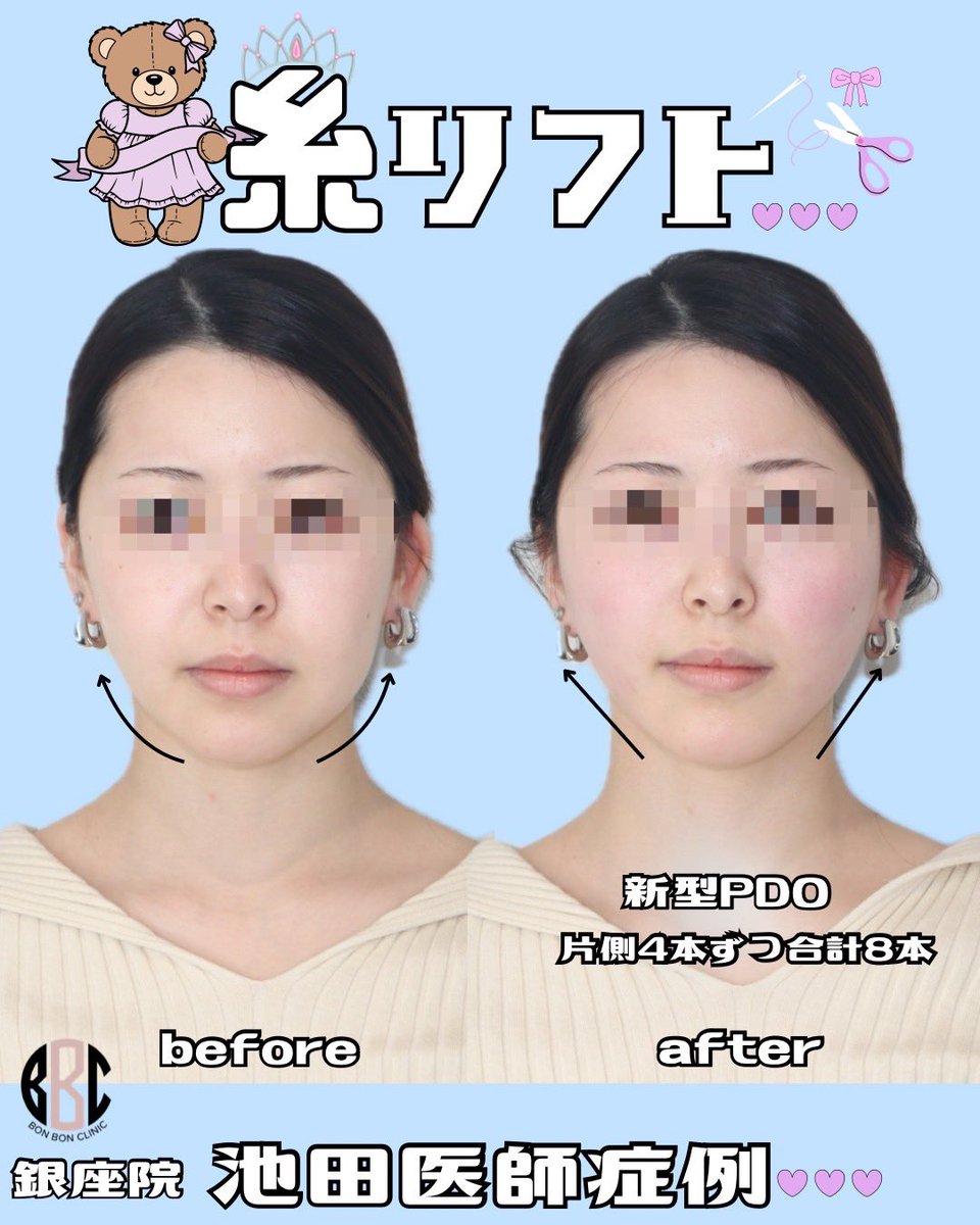 BONBONCLINIC's tweet photo. 銀座院✔️はる先生の糸リフト👩🏻‍⚕️✨
キレイな輪郭へ大変身で垢抜け大成功🪄✨💝

ヒアル・ボトックス・カベリンも
お得なクーポン🎁LINE限定で配布中🌈

📲今すぐチェックしてねっ💌

☎️03-6263-8261
LINE▶️【@bonbonclinic】で検索🔍

#銀座美容 #bonbonclinic #糸リフト #ヒアルロン酸 #ボトックス https://t.co/RQM8R61cAU