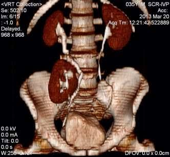 Kidneys went CAPUT.

What is this?