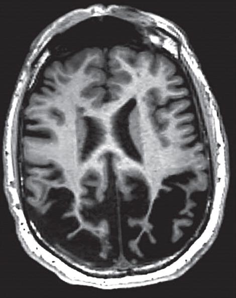A 66-year-old man presents with a 6-year history of progressive visual symptoms, difficulties getting dressed and reading.

What is this?