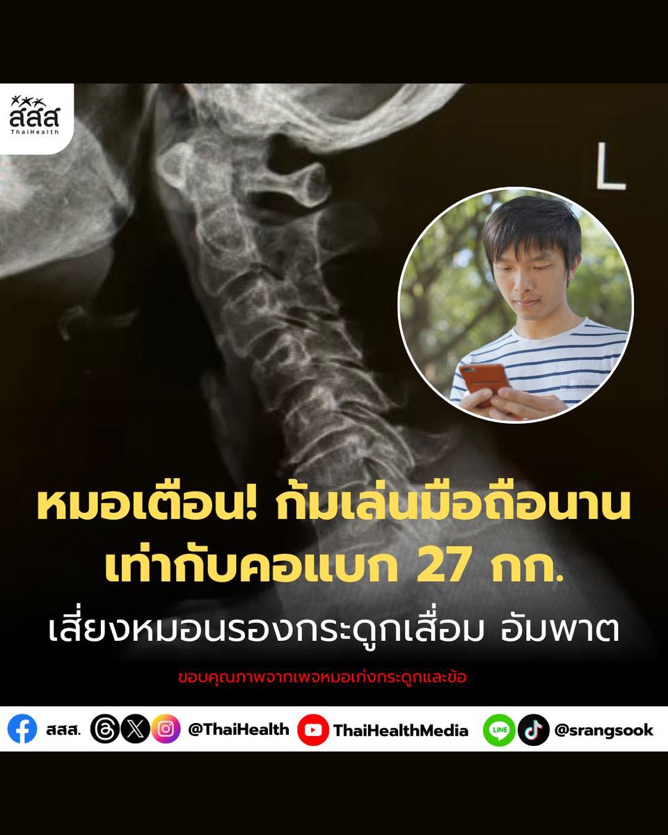 ก้มเล่นมือถือวันละหลายชั่วโมง… รู้ไหมว่าคอคุณกำลังแบกน้ำหนักถึง 27 กิโลกรัม ทุกวัน! 😰

หมอเตือน! ปกติหัวคนเราหนักแค่ 4–5 กก. แต่พอก้ม 60 องศา แรงกดจะพุ่งสูงแบบทวีคูณ ทำให้ “หมอนรองกระดูกคอ” เสื่อมเร็ว แบน ปลิ้น และกดทับเส้นประสาท

⚠️ อาการที่ไม่ควรมองข้าม
- ปวดคอเรื้อรัง