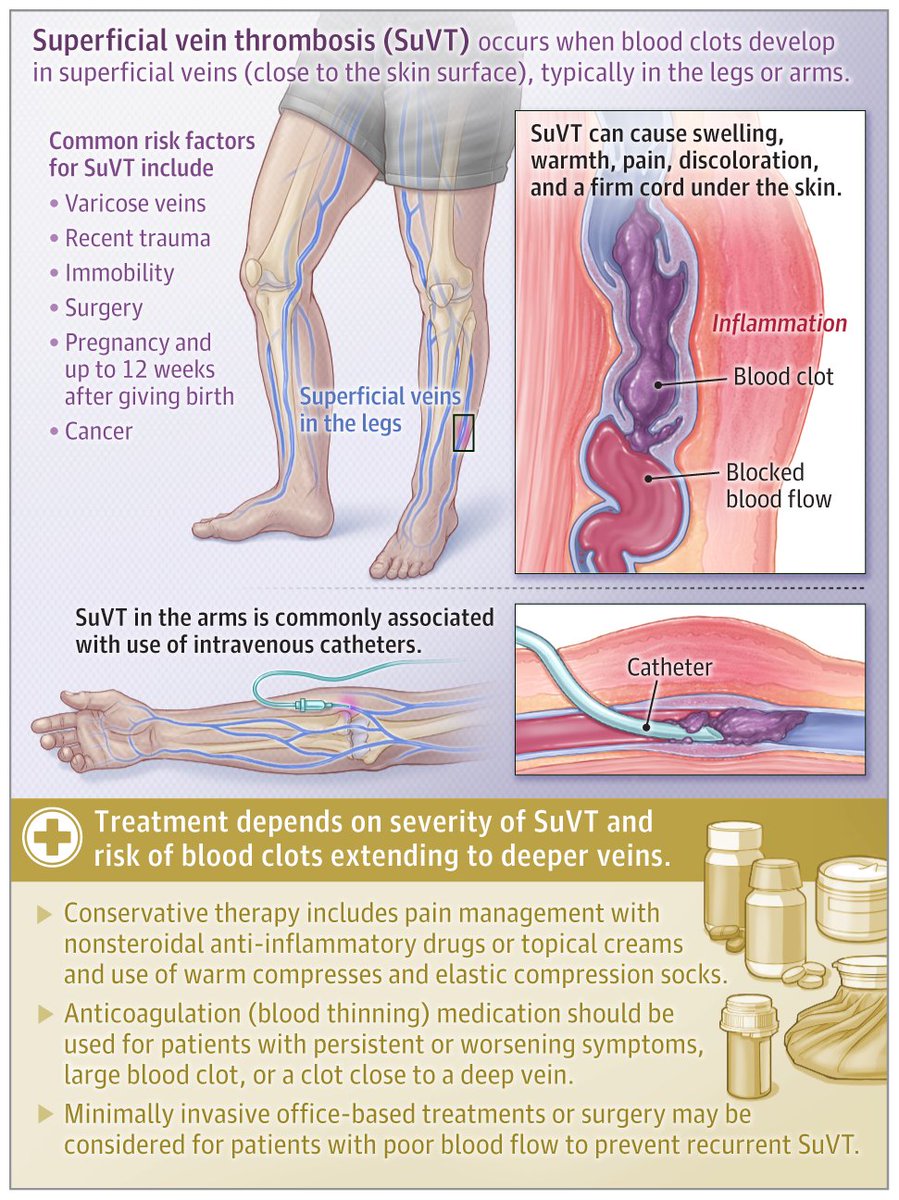 Superficial vein thrombosis is a condition in which blood clots develop within the superficial veins, typically in the legs or arms.  

📄 This JAMA Patient Page describes its risk factors, symptoms, diagnosis, and treatments. 

ja.ma/3ZtfBMP