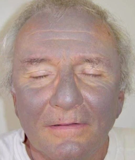 This skin discolouration is most likely caused by which drug?

A.Amiodarone
B.Hydrochlorothiazide
C.VANCOMYCIN
D.Spironolactone 
#ImranKhanEyeEmergency 
#ImranKhanHealthEmergency #Yeralti #ชลบุรีเขต1