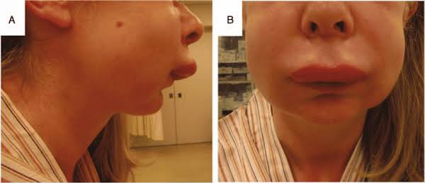 A patient presents with recurrent swelling of the face and lips as shown with vomiting and diarrhea when emotionally stressed. What is the most likely deficiency?

A. C1 inhibitor
B. C2
C. C3
D. C1, C2, C4

#neetpg2026 #MedTwitter <a href="/DrAkhilX/">Dr. Akhil 🇮🇳</a> <a href="/DocPriyamMD/">Dr. Priyam Bordoloi</a> <a href="/Dr_Shiv_kumar_/">Dr. Shiv_Kumar</a>