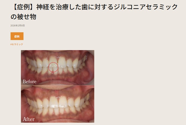 setagaya_DC's tweet photo. 症例をUPしました！！
【症例】神経を治療した歯に対するジルコニアセラミックの被せ物
https://t.co/fnVlfnCWpn

#歯科医院 #歯医者⁠
#せたがや歯科室 #松陰神社 #松陰神社前 ＃症例UP #セラミック https://t.co/L1kIzPRysb