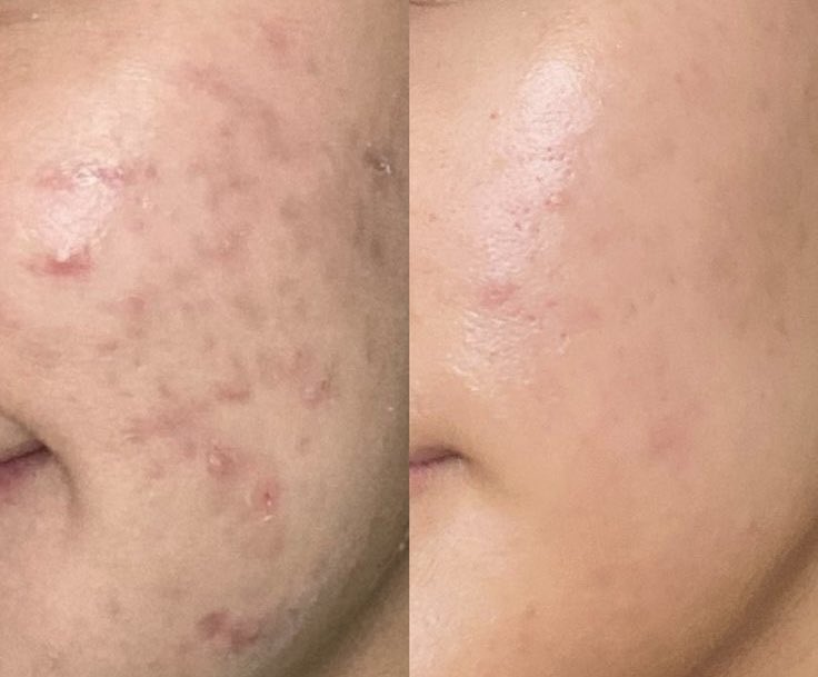 theothermimi_'s tweet photo. KENAPA AKU BARU TAHU CREAM LA ROCHE-POSAY NI BAGUS GILA????? 😭😭 

Pakai ni sebelum tidur bangun pagi jerawat dah kecut wehhhh. Kulit irritated terus lega. Worth it walaupun mahal sikit. Pregnant &amp; bf mom pun boleh pakai ni￼ https://t.co/3Kl1TzyUlF
