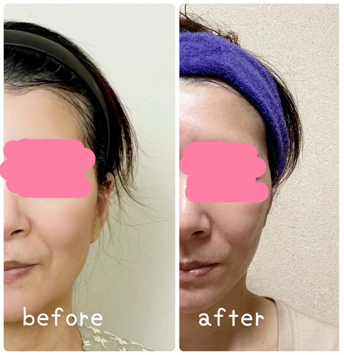 kiko 切開リフトDT中 tweet media