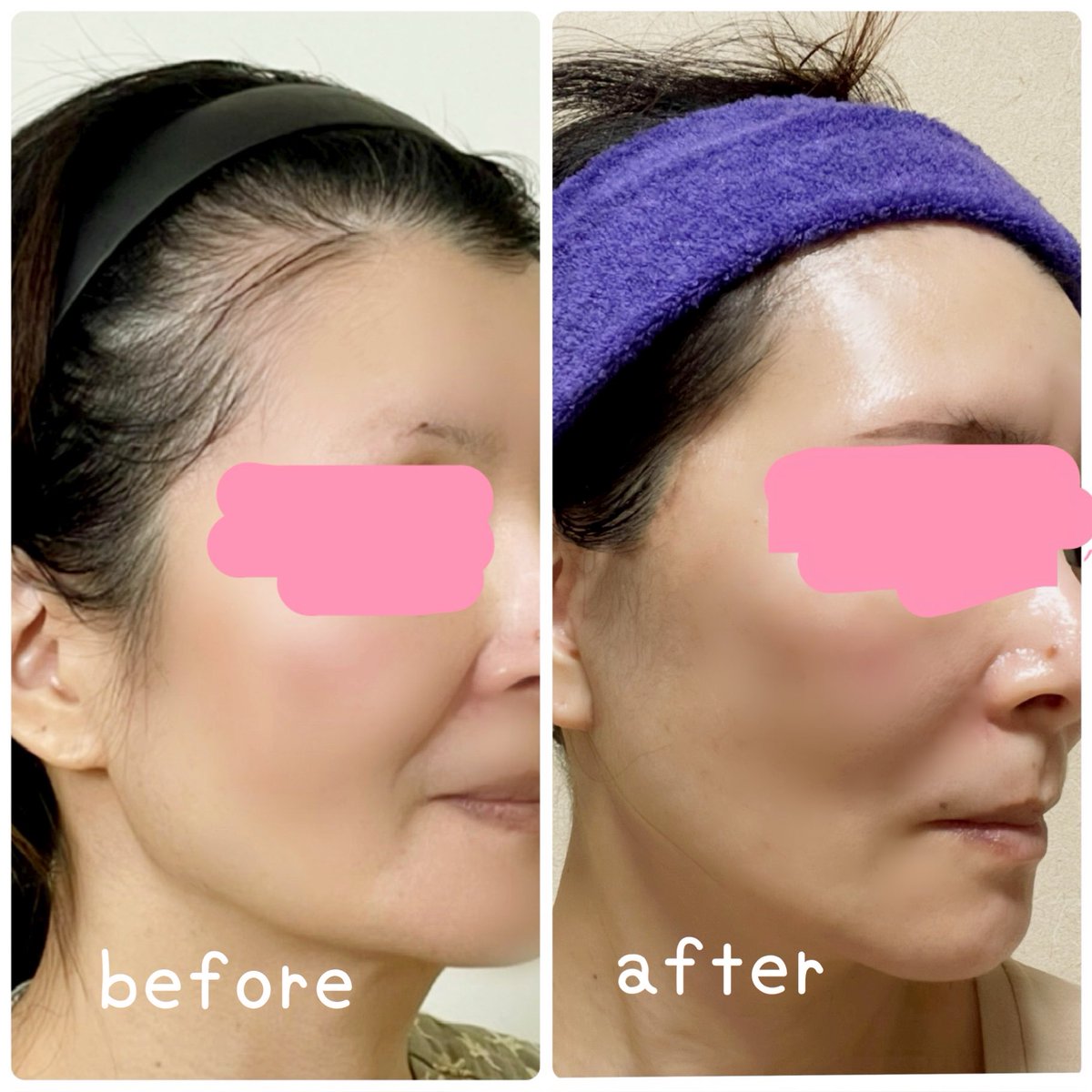 kiko 切開リフトDT中 tweet media