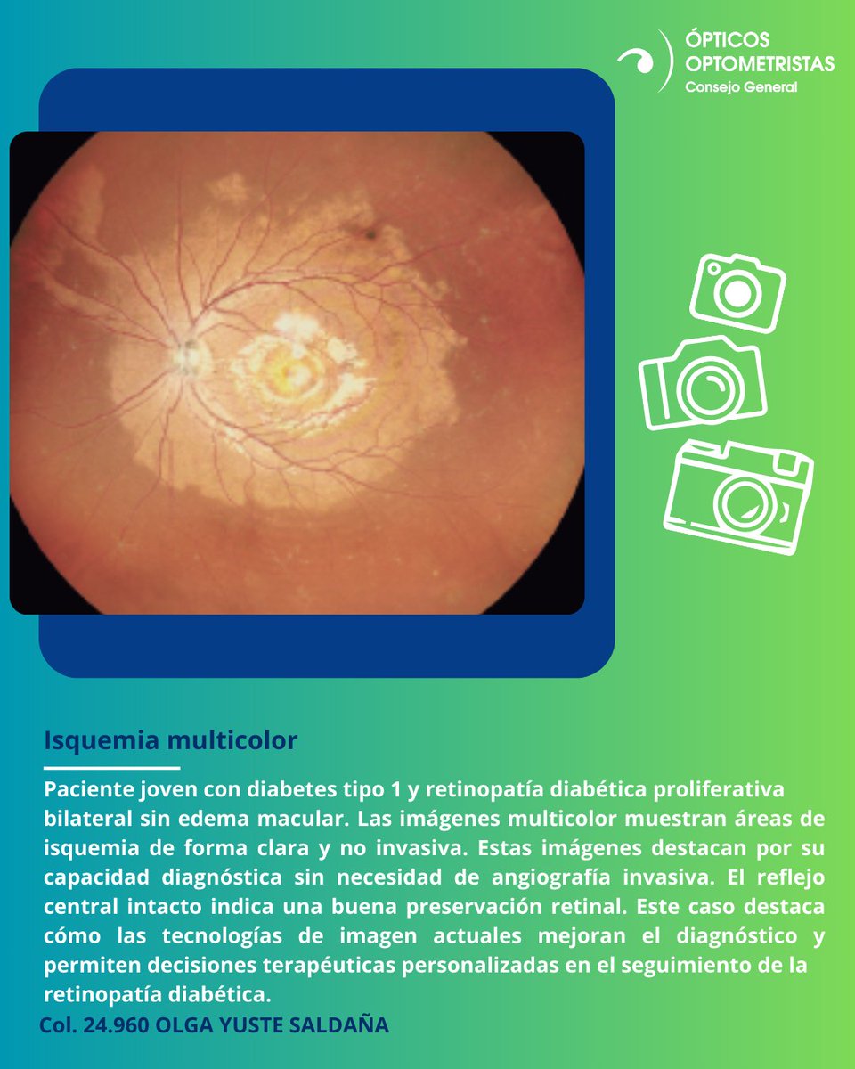 Cgcoo_es's tweet photo. 🏆📸#ConcursoFotografiaCientificaOcular | Foto seleccionada para optar al premio Carlos López H. de fotografía ocular Topcon España 
#LaGacetaCGCOO #Gaceta619 #isquemia https://t.co/VG2X5hBdaH