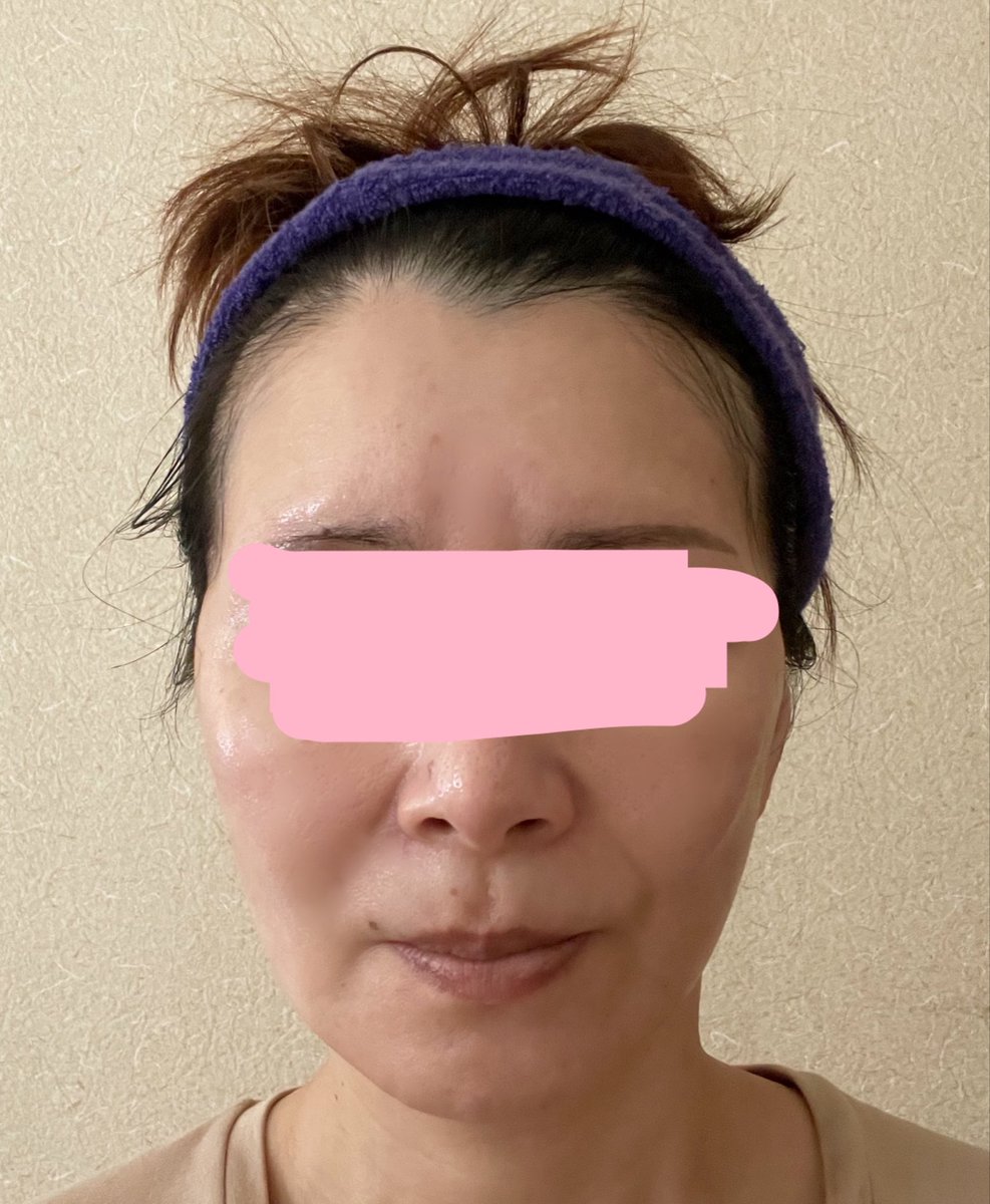 kiko 切開リフトDT中 tweet media