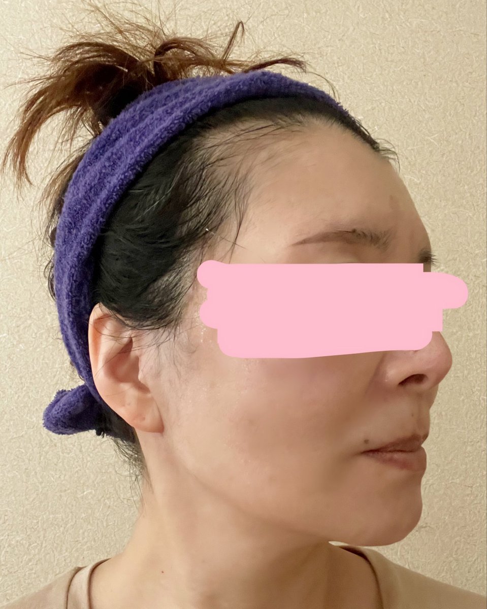 kiko 切開リフトDT中 tweet media