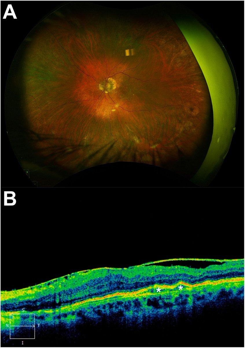 lrohowetzmd's tweet photo. Check out our new paper in AJO Case Reports!

We report a rare case of recurrent intravitreal injection–associated endophthalmitis occurring in the same eye 2 years apart.

https://t.co/bg3wLnlSix 

#Ophthalmology #Retina #Endophthalmitis https://t.co/uHtKGtb8kH