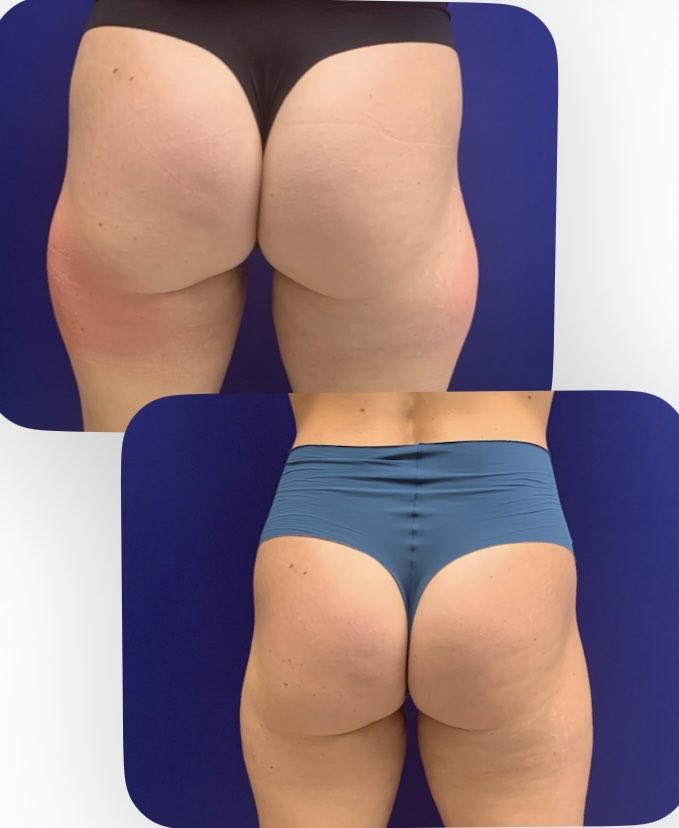 EekhoffMarci's tweet photo. COOLSCULPTING BEFORE &amp; AFTER
What a difference a small reduction and softening makes!!!! https://t.co/DYRxGEzv23