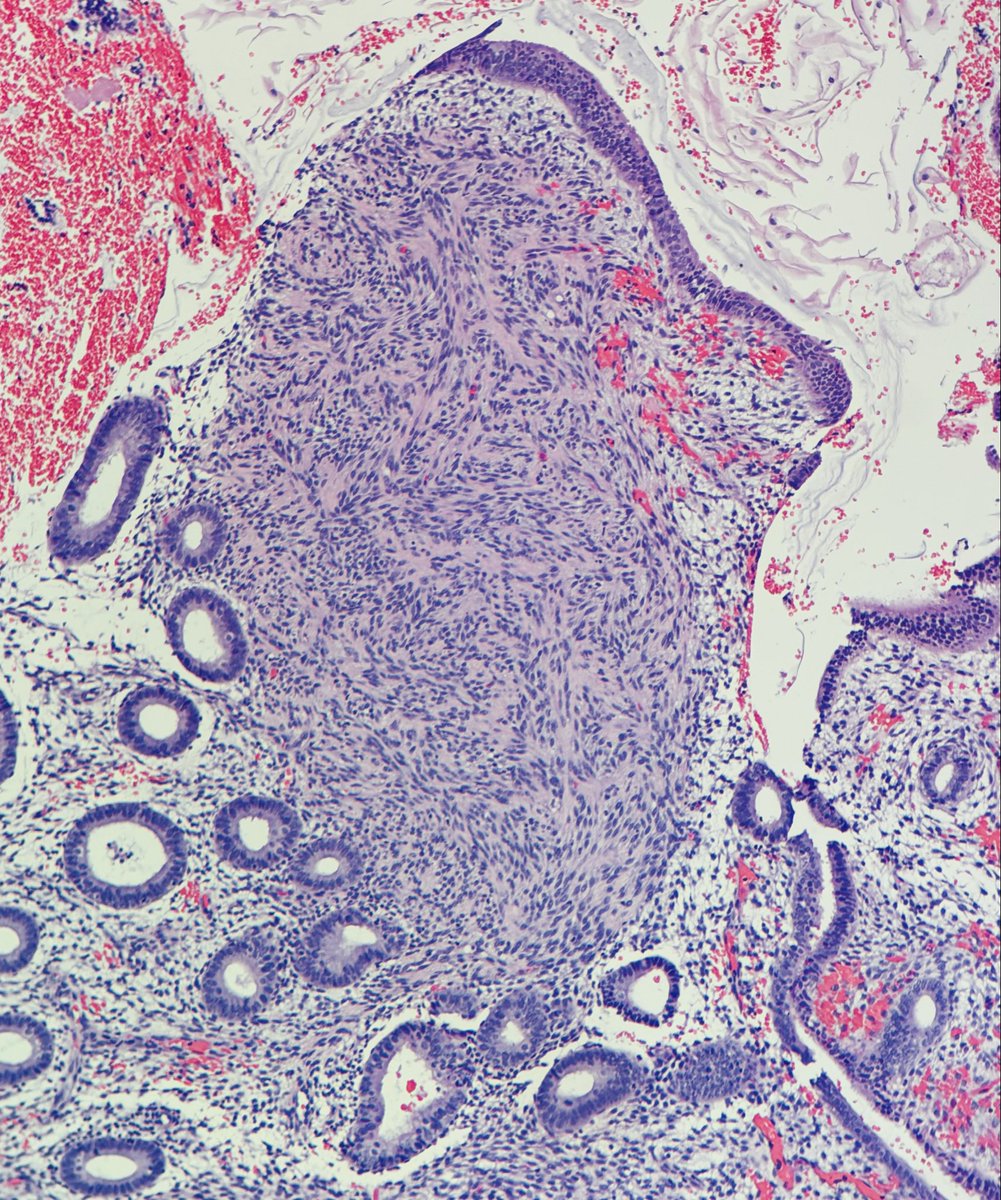 Janiranavarro's tweet image. Endometrial metaplasias:
- Myomatous stromal metaplasia  

Desmin stain (Pic 2)
Incidental finding 

#everydayGYN #pathology #PathX