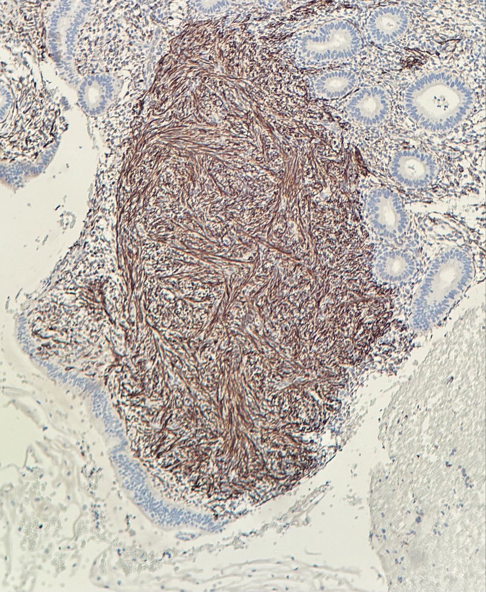 Janiranavarro's tweet image. Endometrial metaplasias:
- Myomatous stromal metaplasia  

Desmin stain (Pic 2)
Incidental finding 

#everydayGYN #pathology #PathX