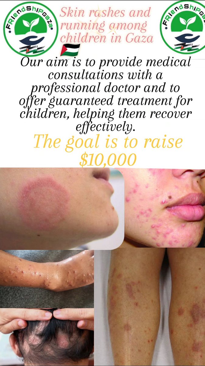 ShipGaza97470's tweet photo. Emergency medical initiative for children in Gaza 🇵🇸
Many children experience skin problems such as rashes and scabies.
Unclean water, poor living conditions, lack of cleaning supplies 
We will contract with a dermatologist and cosmetic surgeon and provide essential treatment. 🇵🇸 https://t.co/6khntTJJOE