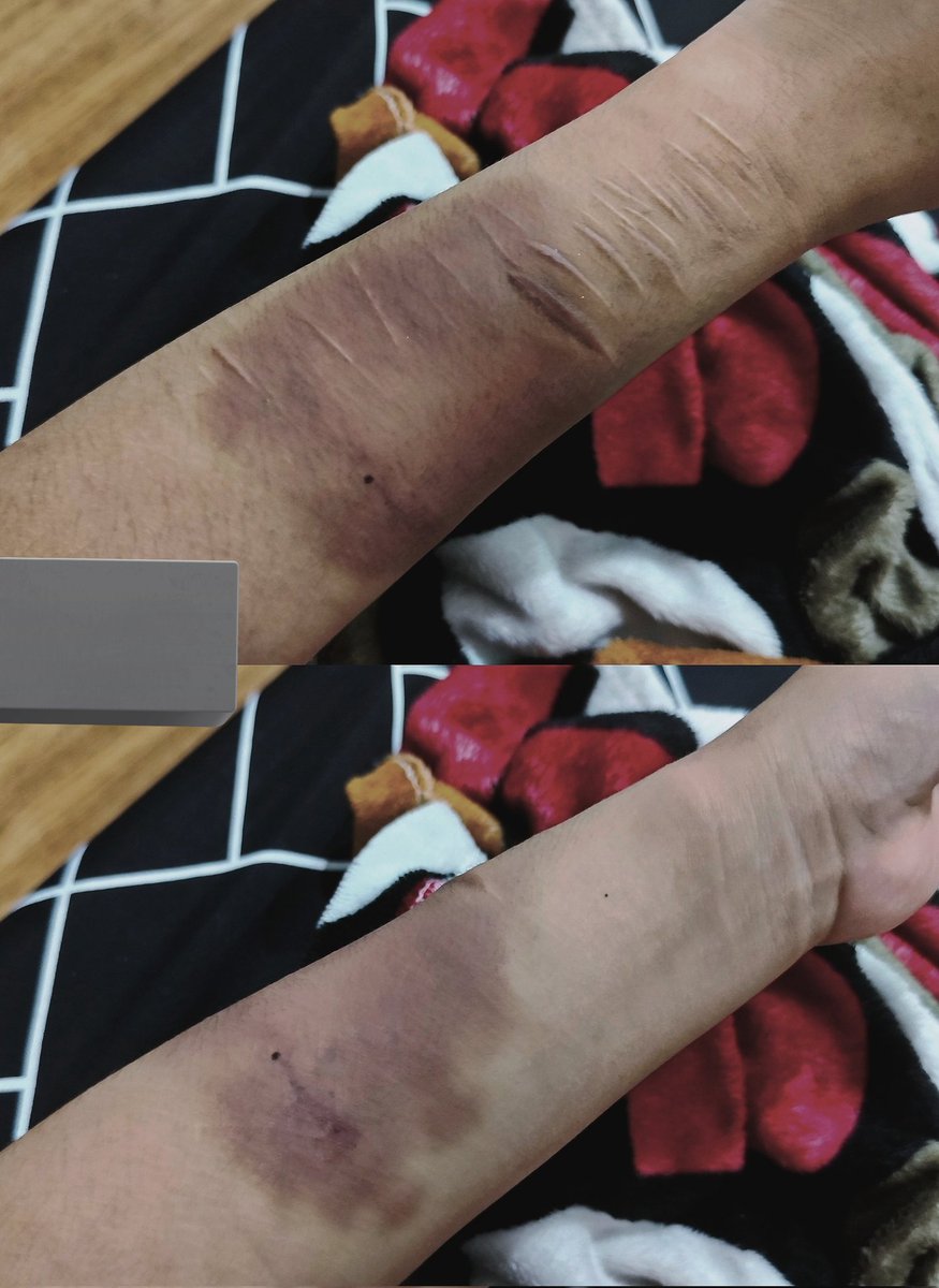 TRASHYCAKES's tweet photo. day 2 of my self-hitting bruise by using my phone and hitting it to my arm alot of times with force lol, ive never actually done this form of sh before it actually feels great https://t.co/IElQT8mchQ