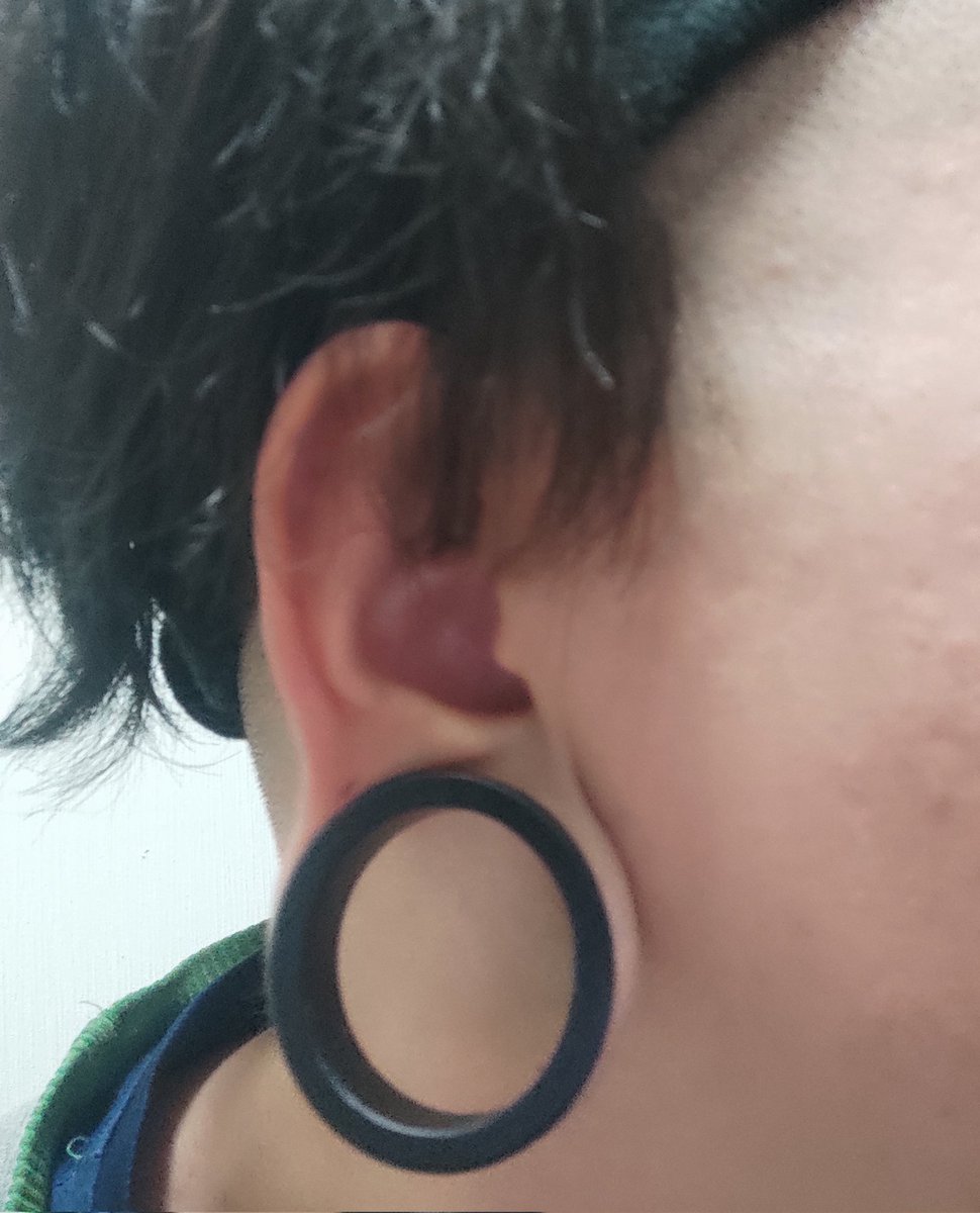 Ryotapooon's tweet photo. 遂に右耳もピアス空けた。
左耳と同じ福耳にしたいね、今めっちゃ福が薄いからね。
最速1年くらいかなぁ https://t.co/990Nucjx5u