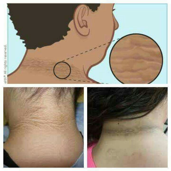 What are the early warning signs of insulin resistance?

These 8 signs may surprise you.

You might want to rethink your day-to-day lifestyle after reading this:

1/ You have skin tags or dark patches... 🧵