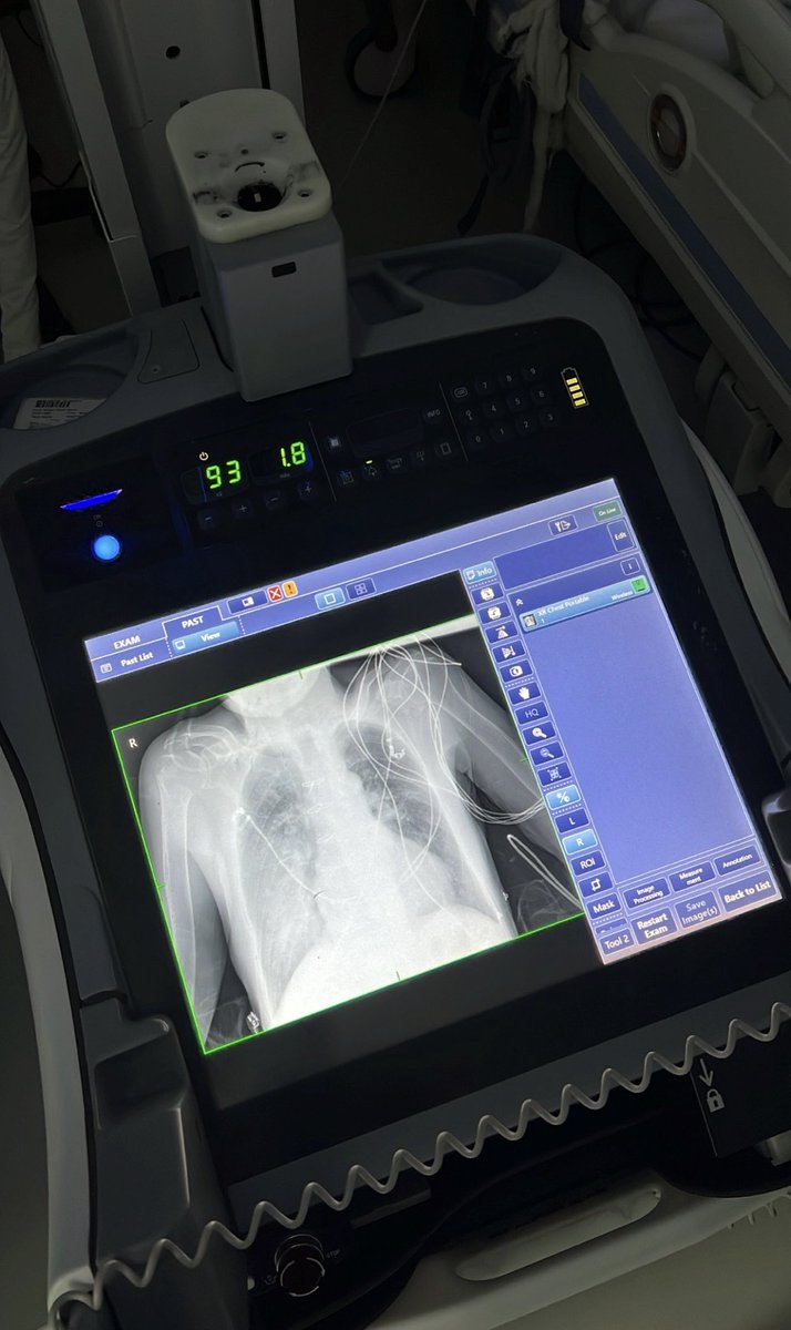 Abotr_12's tweet photo. أصعب ما في مهمة اخصائي الأشعة لما يشتغل على ال Portable x-ray مهب ثقل الجهاز ، بل ثقل النظرة التي يرمقك بها مريض العناية اللي شبه فاقد وعيه وهو عاجز عن الحركه ، في ذيك اللحظة اللي تسبق التصوير ، كن أنت الأمان اللي تدور لها عيونه التائهة وسط الأنابيب والأسلاك . https://t.co/eS4yKYiBoP