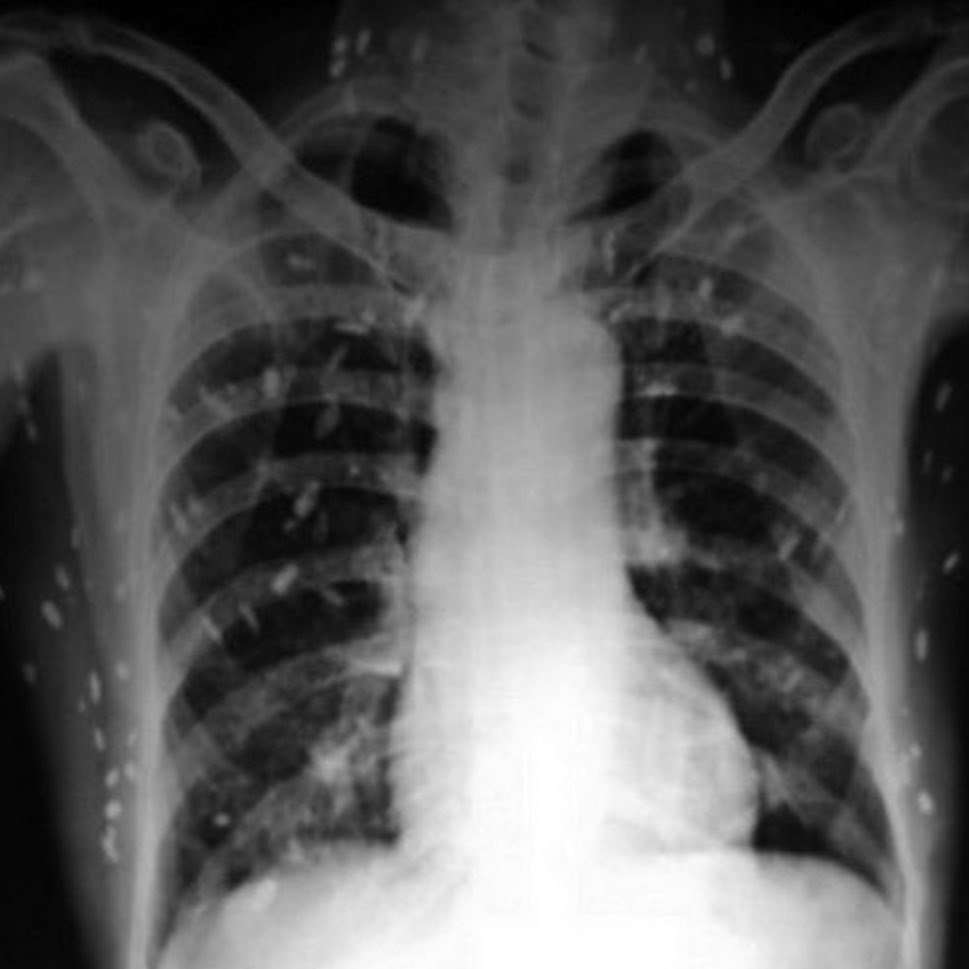 Yurtdışında bir Hasta, parmaklarında ve bileklerinde ağrı ve sızı şikayetiyle hastaneye başvurdu.

— Fiziksel muayene, kan testleri ve göğüs röntgeninden sonra doktor hemen tüm vücut röntgeni çekilmesini istedi.

Radyografi sonucu: