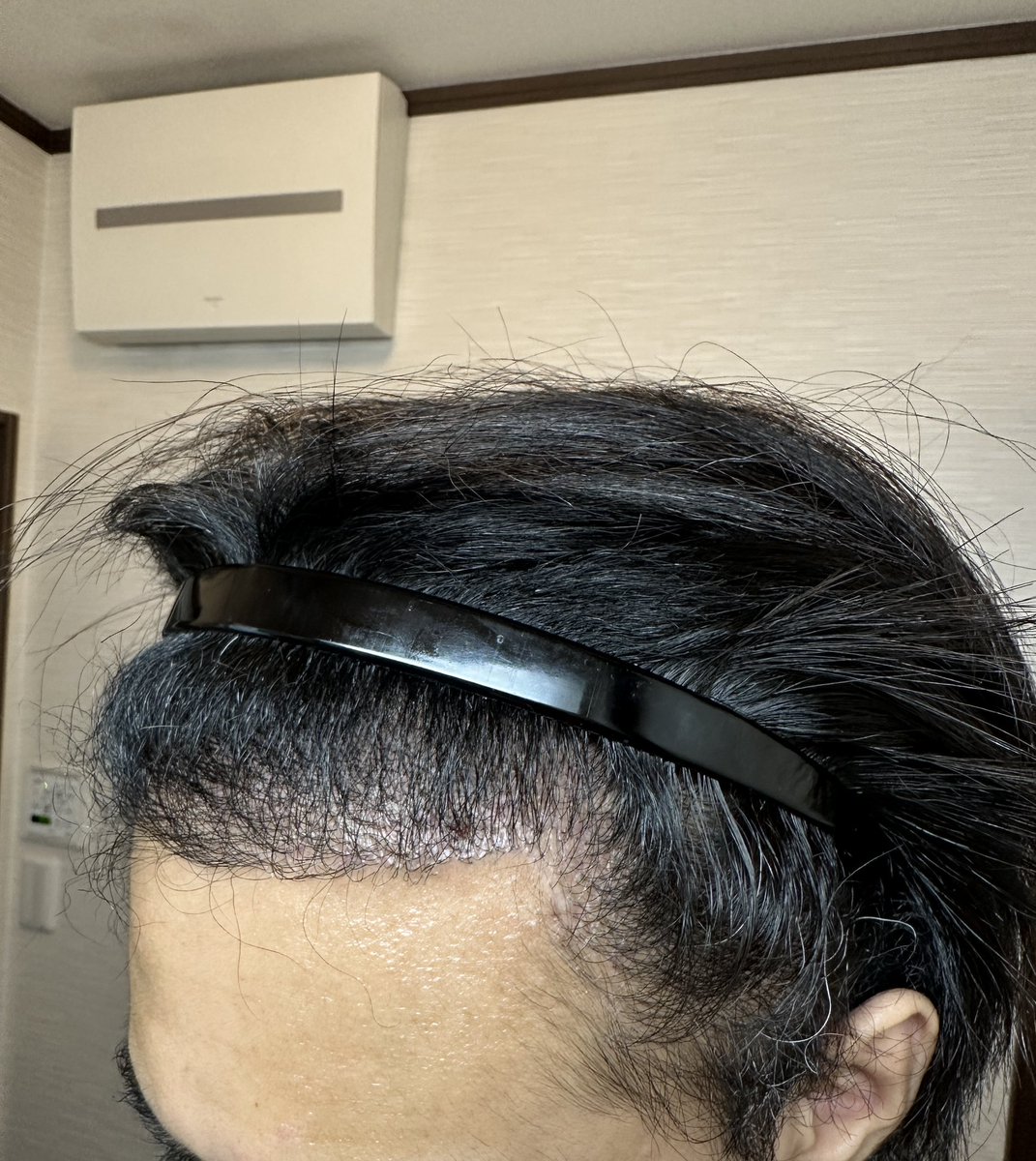 hage_blog's tweet photo. 湘南美容クリニックで植毛して半年が経過

もっと生えてる想定だったので、ぶっちゃけ不安…

成功か失敗か、答え合わせはあと6ヶ月

生え際が不自然なのもちょっと後悔

ちなみに植えたのは2300グラフトほど https://t.co/ZLafCehMsq