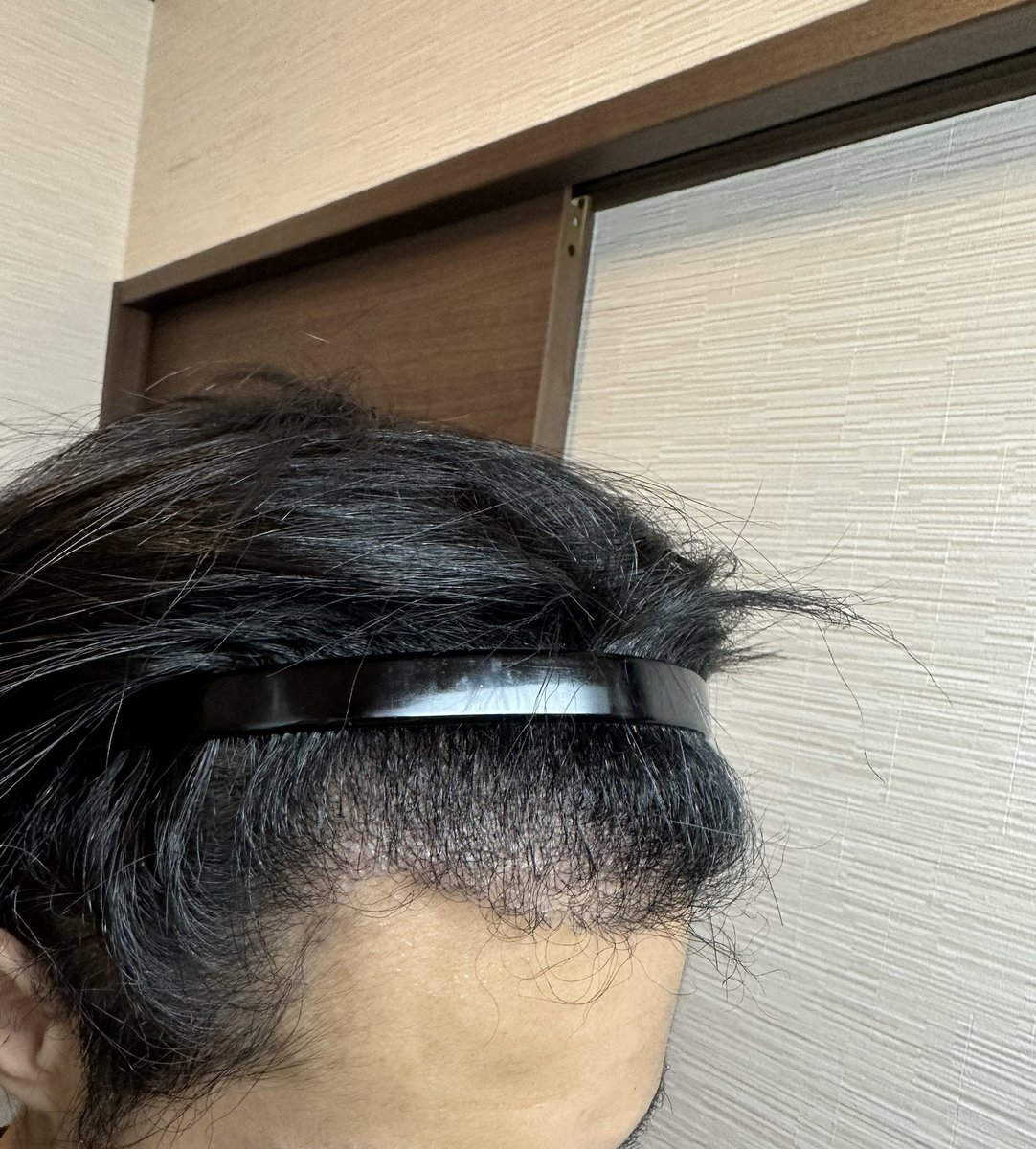 hage_blog's tweet photo. 湘南美容クリニックで植毛して半年が経過

もっと生えてる想定だったので、ぶっちゃけ不安…

成功か失敗か、答え合わせはあと6ヶ月

生え際が不自然なのもちょっと後悔

ちなみに植えたのは2300グラフトほど https://t.co/ZLafCehMsq
