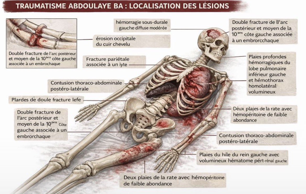 ndmgttnd's tweet photo. 💔 Vérité et Justice pour Abdoulaye Ba
Le rapport d’autopsie évoque de multiples traumatismes graves comme cause du décès. Ces révélations bouleversent et interpellent profondément.
Nous ne cherchons ni conflit ni division. Nous demandons simplement la vérité. https://t.co/cbtpJKehQ9
