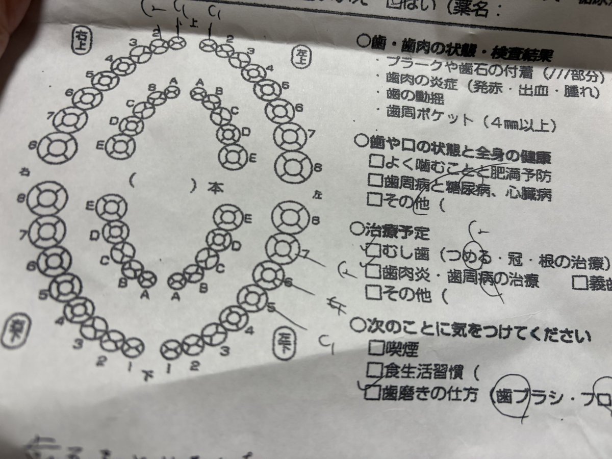 歳とると歯と歯の隙間が広くなりカスがたまり、化石のように歯垢となる