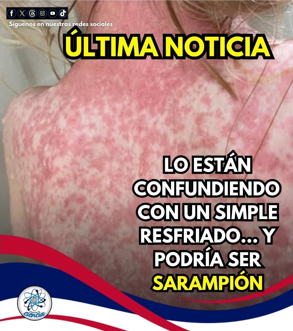 🚨📰 ATENCIÓN 

Muchas personas comienzan creyendo que es solo gripe: fiebre, tos, moqueo y ojos rojos. Pero cuando la fiebre se dispara y aparece un sarpullido que inicia en el rostro y se extiende por el cuerpo, ya no estamos hablando de algo leve.

El sarampión es una
