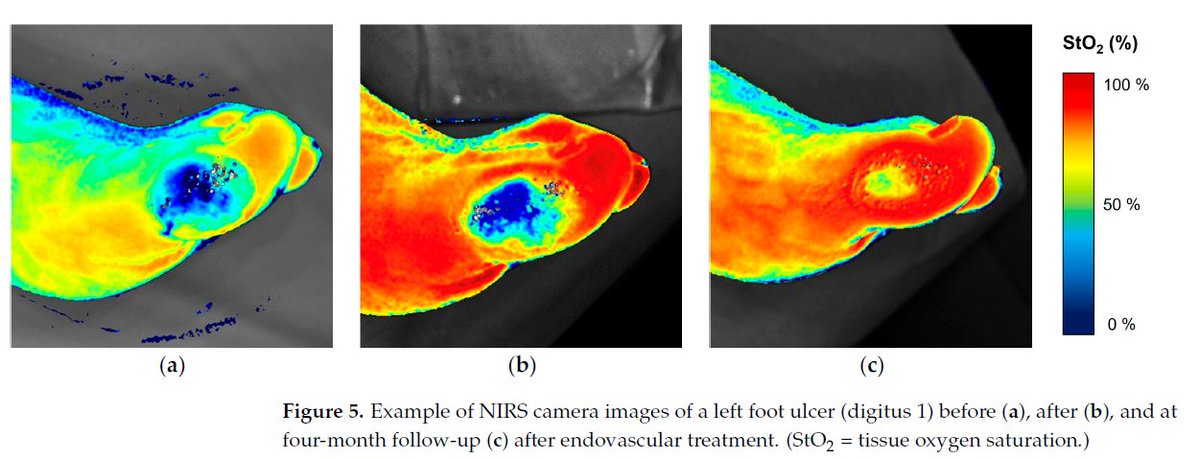 "NIRS is particularly reliable for low-risk wounds with small or no areas of gangrene/necrosis, which are common in clinical practice."

Read more and download: hubs.la/Q042nj700

Figure 5. Licensed under CC BY 4.0 (hubs.la/Q042nldP0). Source: hubs.la/Q042nhWg0.