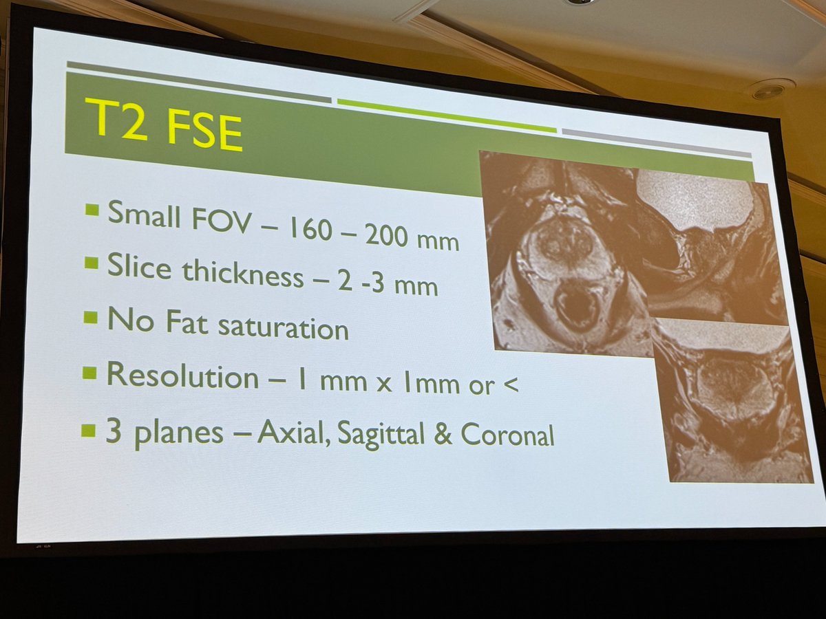 MoffittNews's tweet photo. Live from #AdvancesInUrology: Brandon Manley, MD walks urologists through Prostate MRI 101, discussing why imaging matters and key criteria that can help inform prostate cancer decision-making.

Key takeaways:
• MPR MPRI is the gold standard for prostate cancer detection and staging.
• MRI technique and quality control is crucial.
• Prostate cancer can be multifocal.
• Transition zone cancer is not as uncommon.
• Large FOV images for evaluations of LNDS and bones.
• Awareness of pitfalls.